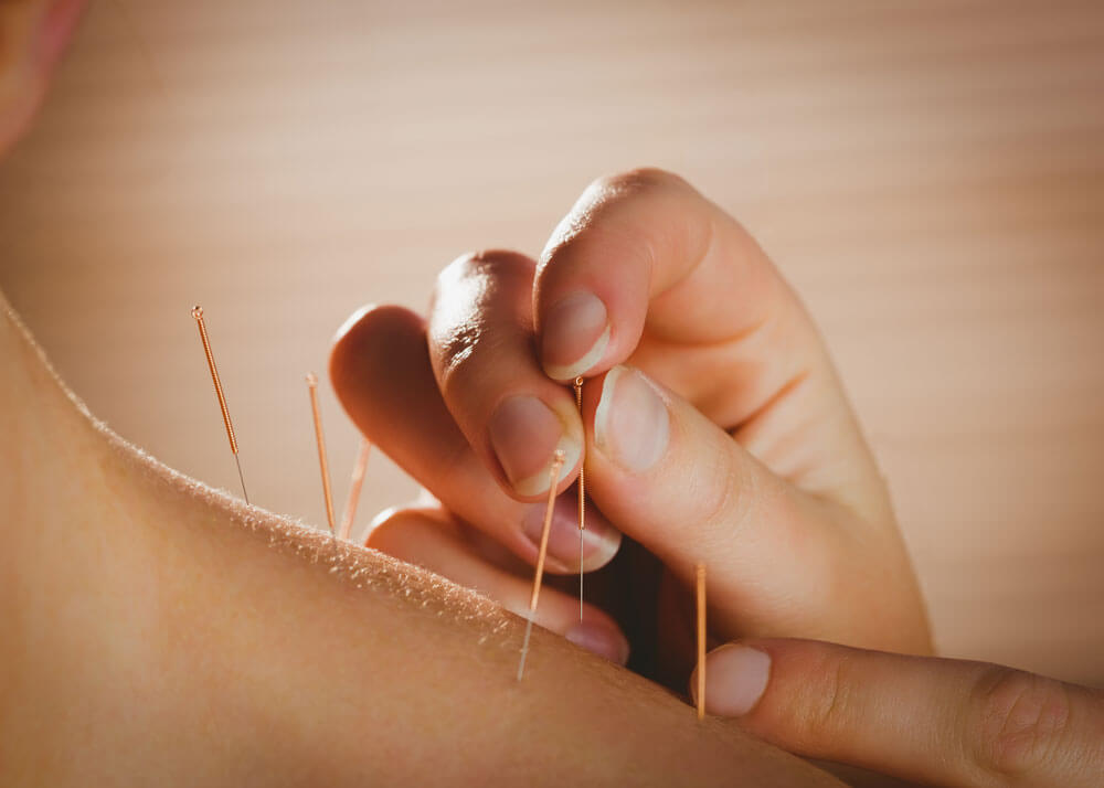 Close-up of a hand inserting acupuncture needles into someone's skin.