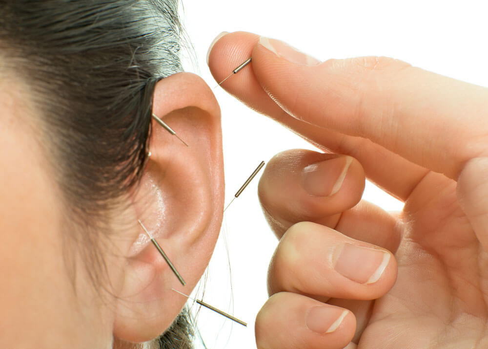 Close-up of a hand inserting acupuncture needles into different parts of an outer ear.